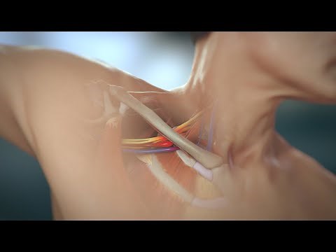 Thoracic Outlet Syndrome Surgical Animation