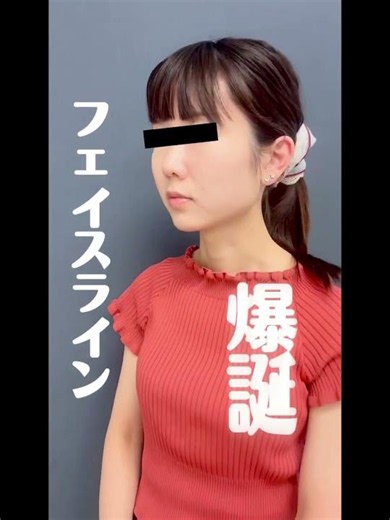 【フェイスライン、こんなに変わる✨20代/女性お顔の脂肪吸引+エラボトックス🤍顎下のボリュームが減ることで、Eラインも整いやすく、バランスの良い横顔に◎一人ひとりの骨格やバランスに合わせてデザイン✨