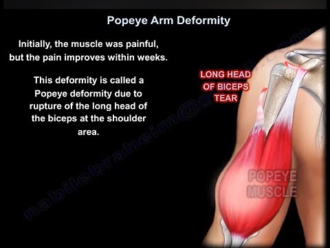 Proximal Biceps Tendon Rupture / Popeye Deformity -