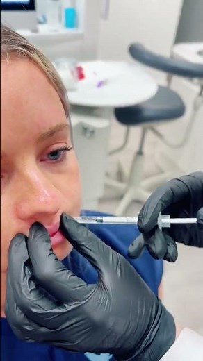 Lip Flip: Before & After