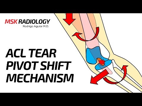 Pivot Shift Mechanism of ACL tear - How the MRI Bone Marrow Edema Occurs