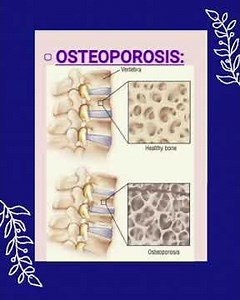 Skeletal system disorders