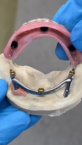 29 reactions · 5 comments | Lower Process Locator Denture with a Hybrid Bar! Case from Dr. William Bennett in Illinois! | CEO Luke Kahng | Facebook