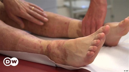 How to treat scalds and burns and prevent scars