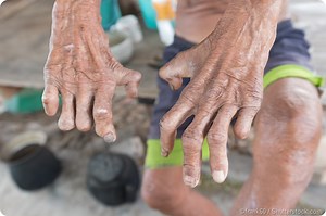 Leprosy Stigma