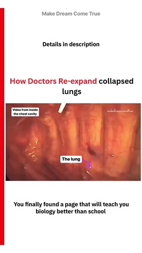 🫁 How Doctors Re-expand collapsed lungs 🧑‍⚕️ | MDCT