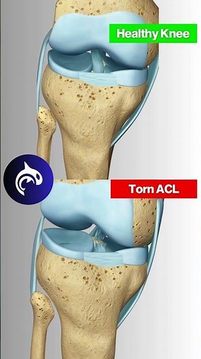 Why ACL Tears are such a nightmare for athletes #acl