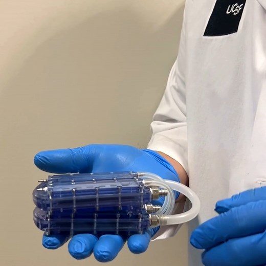 The Kidney Project on Instagram: "Here is a video of one of The Kidney Project’s researchers explaining the two components of the implantable bioartificial kidney. The prototype of the artificial kidney is made possible with the help of ANSYS software, which is a set engineering simulation tools that allow our researchers to model the complex design features of the device. The intent of the implantable bioartificial kidney is to provide the benefits of a donor organ and eliminate the burdens of