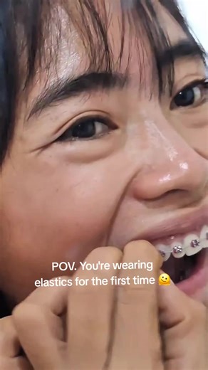 Navigating Your First Experience with Braces Elastics