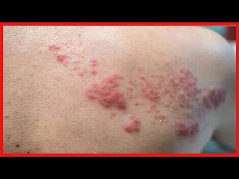 Hautausschläge: 10 Arten und ihre Symptome