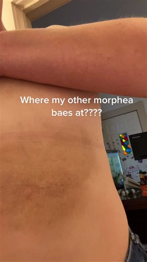 Understanding Morphea: Symptoms, Causes, and Treatment Options