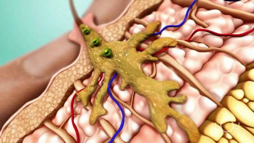 Teen Acne Medical Animation - eLearning Program for Middle School Health Class