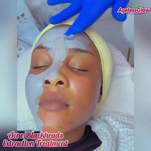 Question often asked about acne/blackheads extraction treatment -...