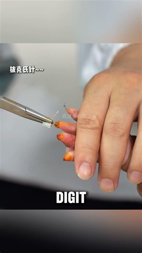 Separating Fused Fingers: A Life-Changing Surgery 🏥 #shorts #suresh