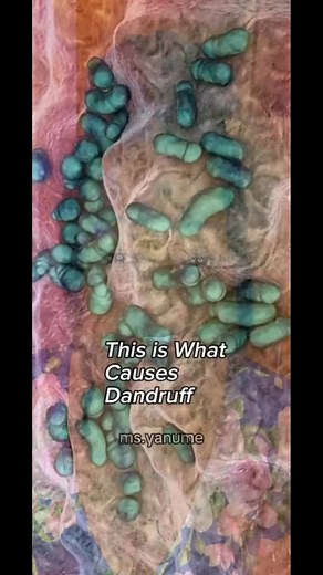 Malassezia is a yeast-like fungus that naturally lives on your scalp and helps keep things in balance. But when it overgrows (thanks to extra sebum production from your scalp), it produces oleic acid, which can irritate the scalp, leading to that dreaded itch and flaking. This is why it is not advisable for a person with dandruff to excessively oil their scalp. It feeds malassezia even more. Here’s the twist: in small amounts, oleic acid is actually good for your hair! In fact, it’s added to man