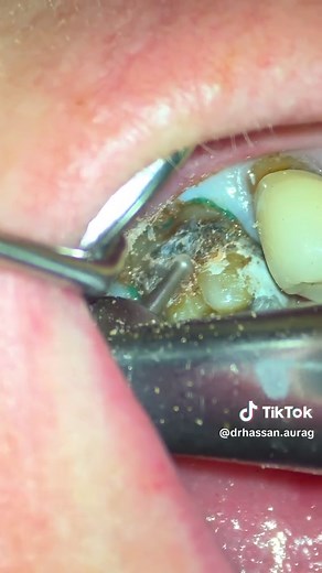 PFM Crown Removal and New Crown Margin Setting Procedure