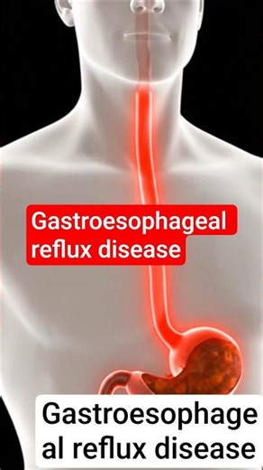 Gerd(Gastroesophageal reflux disease)