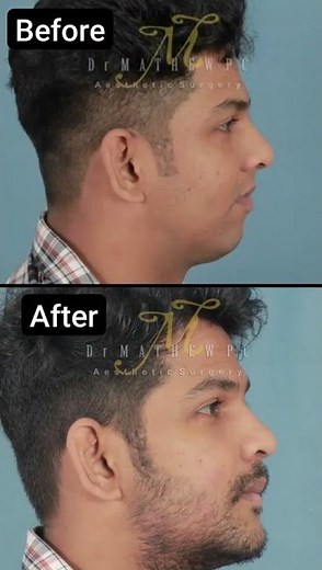 Jawline Transformation After Surgery | Incredible Before & After by Dr. Mathew PC #shorts