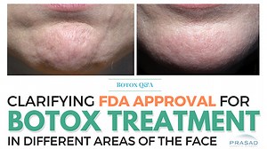 Botox and Off-Label Uses — The Doctor Explains