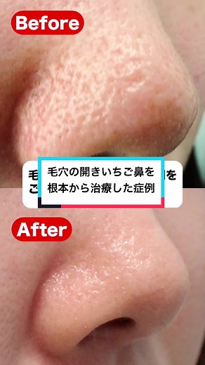 花房式毛穴治療: 鼻の毛穴改善方法とイソトレチノインの効果