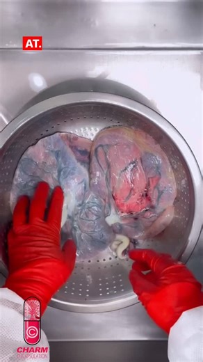 Eri Hernandez PLACENTA ENCAPSULATION CHICAGO on Instagram: "DI-DI (Dichorionic-Diamniotic) Twins • Dichorionic: Each twin has its own chorion, which means they have separate placentas (though in some cases, the placentas may appear fused but are still functionally separate). • Diamniotic: Each twin also has its own amniotic sac. This is the safest type of twin pregnancy because each baby has its own “space” and blood supply, which reduces the risks of complications compared to other twin types. 