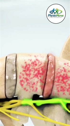 Lumbar decompression helps reduce spinal pressure and improves mobility.