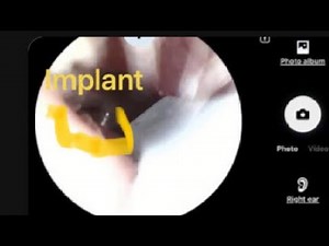 Remote Neural Monitoring