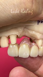 Highly esthetic, 4-unit bridge with tissue characteristics added | Luke Kahng