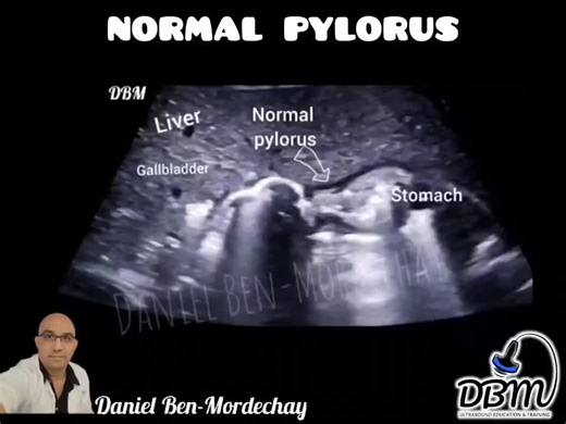 Ultrasound diagnosis of pyloric stenosis vs. normal pylorus in infants | Daniel Ben-Mordechay posted on the topic | LinkedIn