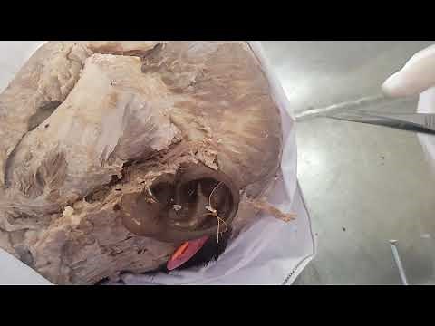 Dissection of Temporal fossa