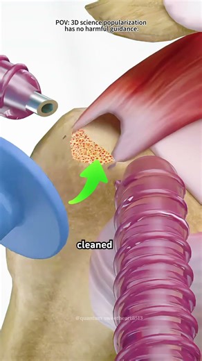 Rotator cuff repair surgery ( 3d animation)