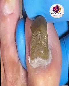 #SimpleHealthTricks #EverydayCare #FootCareTips #FootWellnessUSA | Alfonzo Feil