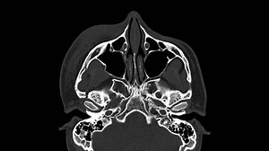 CT scan orbit finding Multiple displaced fracture of right zygoma, extending to anterior wall of right temporomandibular joint.Medical concept.