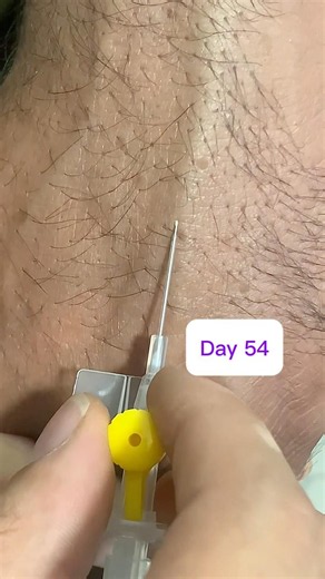 The Perfect Angle for 24G Yellow IV Cannulation! | Day 54 Clinical Skills#shortvideo #viral #safi