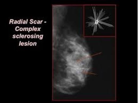 Complex Sclerosing Lesion (Radial Scar) Of the Breast ; Definition, Causes, symptoms, Treatment