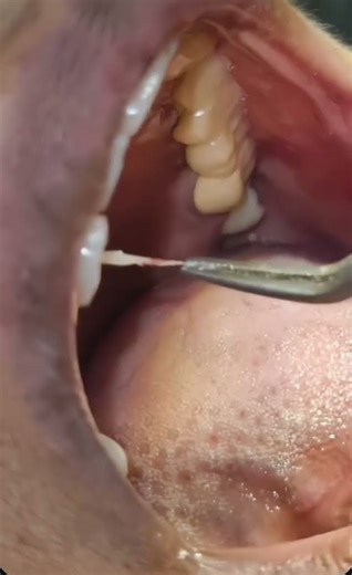 Dental pulp, Root canal treatment.