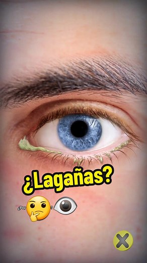 ¿Por qué salen lagañas en los ojos?