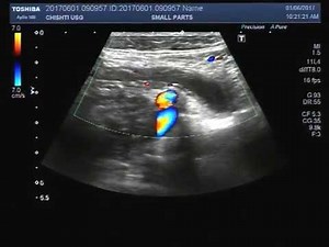 Ultrasound Video showing acute appendicitis.