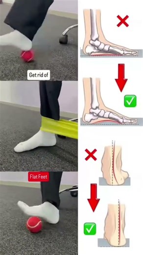 Flat foot #youtube #viral