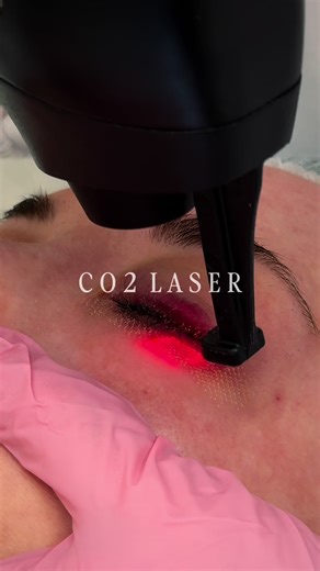 CO2-Laser für effektive Hauterneuerung