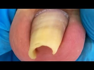 Extremely curly toenails, perfect trimming process【Crazy pedicure room】