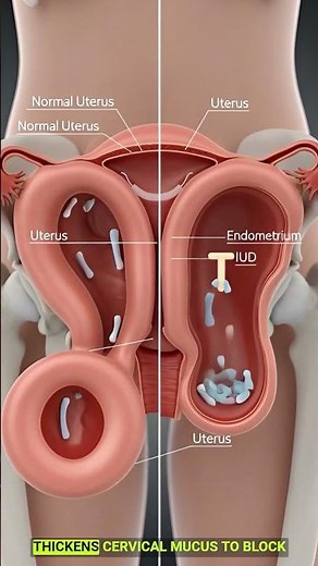 How an IUD Prevents Pregnancy | 3D Medical Animation Explained