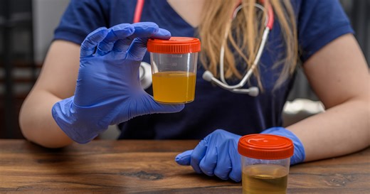 Odcień moczu, który powinien niepokoić. Tak ciało alarmuje o raku trzustki