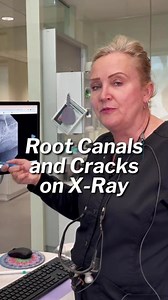 22K views · 245 reactions | 醴嗢Root canals and cracks on X-rays!...