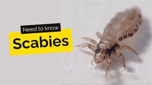 Scabies: What you need to know