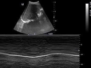 CASE 857 ultrasound normal diaphragm
