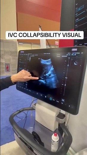 IVC Ultrasound | IVC Collapsibility | How to assess the IVC