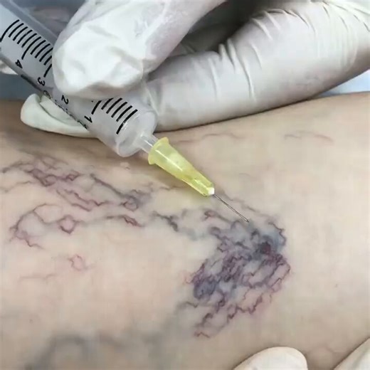 Spider Vein (Telangiectasia) Treatment with Immediate Visible Results