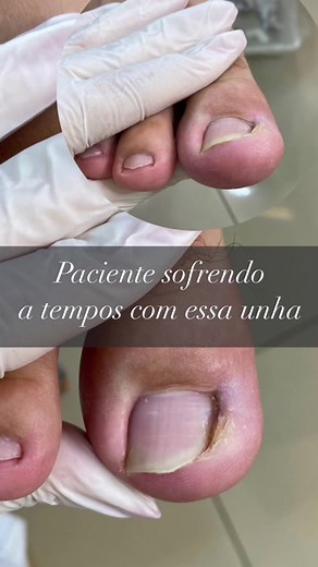 Cuidar de uma unha encravada pode parecer algo simples, mas é extremamente importante não deixar passar muito tempo antes de buscar tratamento adequado. Uma unha encravada ocorre quando a borda da unha cresce e penetra na pele ao redor, causando dor, inchaço e até mesmo infecções. A primeira coisa a se fazer quando se percebe uma unha encravada é evitar cortá-la ainda mais curta, pois isso pode piorar a situação. É importante procurar um profissional de saúde, como um podólogo, para avaliar a gr