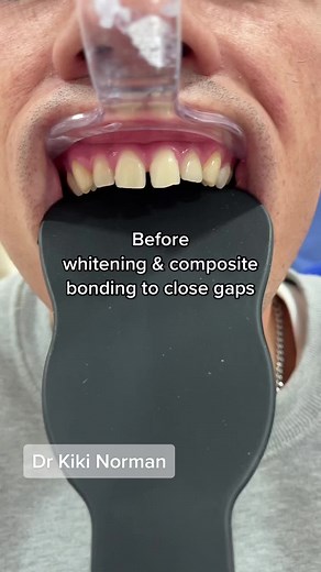 Composite Bonding for Gap Closure: Full Process Video